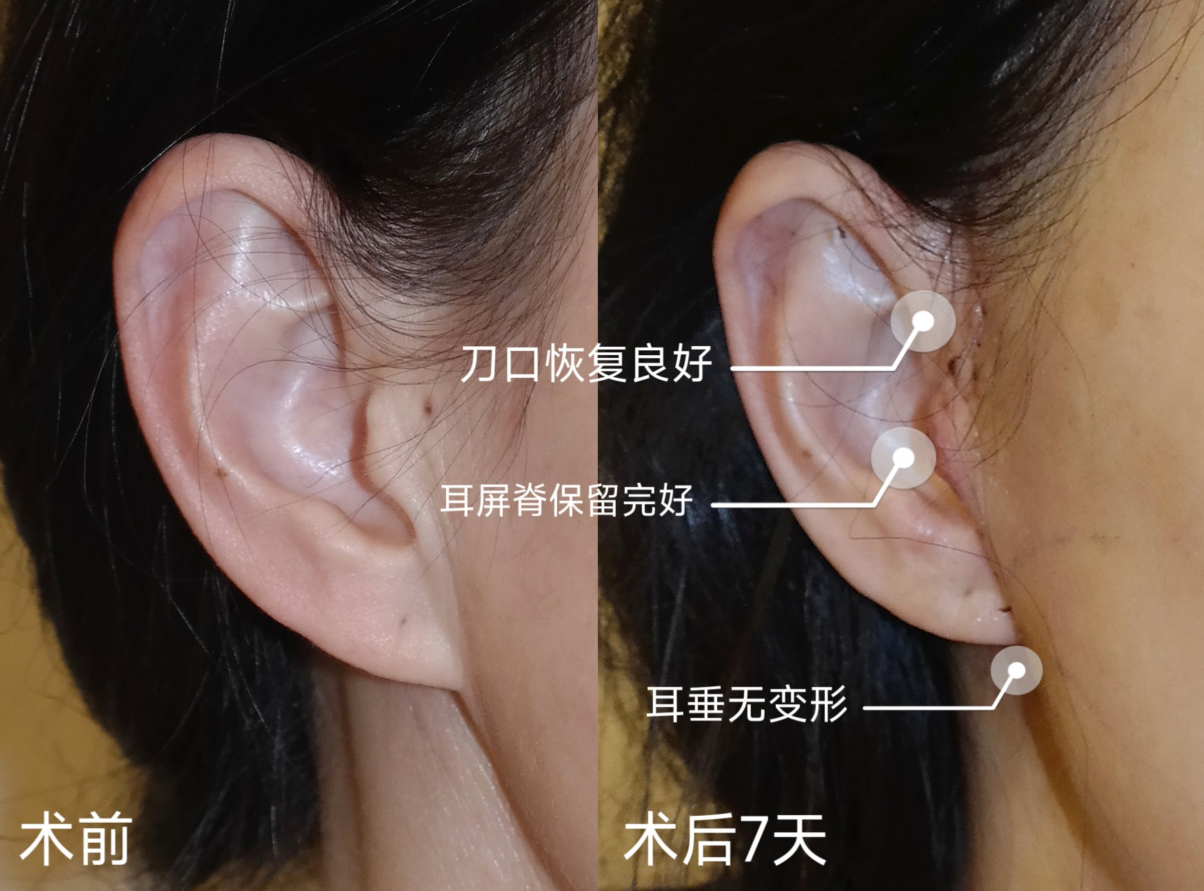 拉皮手术后遗症多吗？到底要不要做？