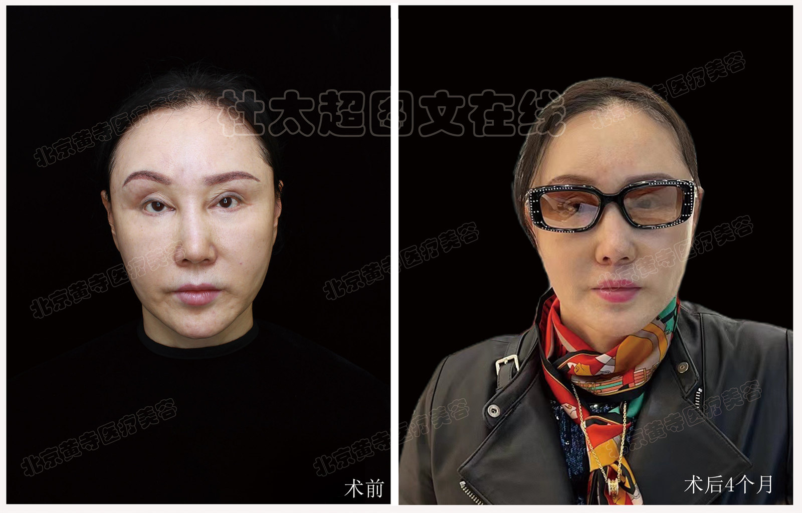 拉皮面部提升术后近期随访4个月