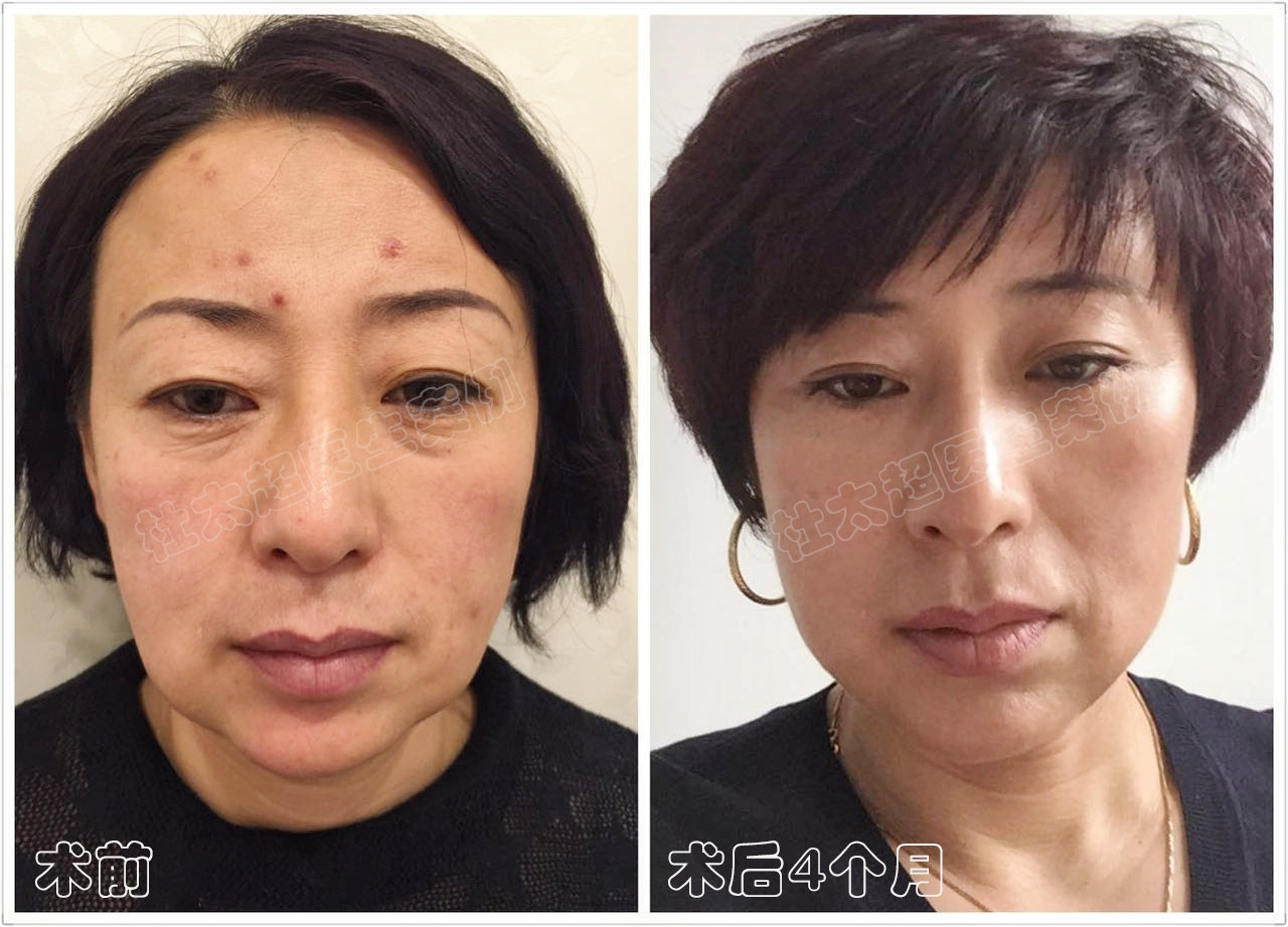 45岁拉皮术后4个月，用亲身经历给大家3个建议