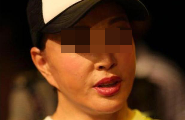 45岁拉皮术后4个月，用亲身经历给大家3个建议