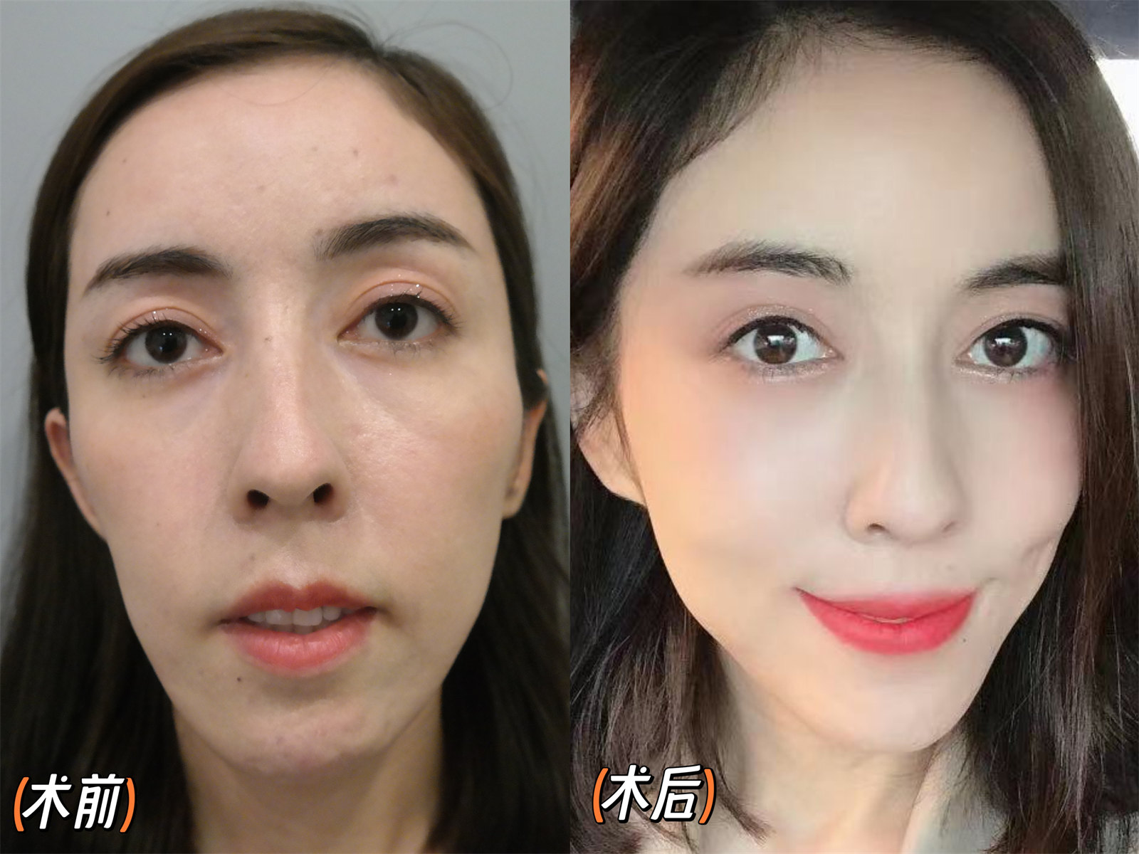 切眉术+小拉皮，微调之后的美，你觉得如何？
