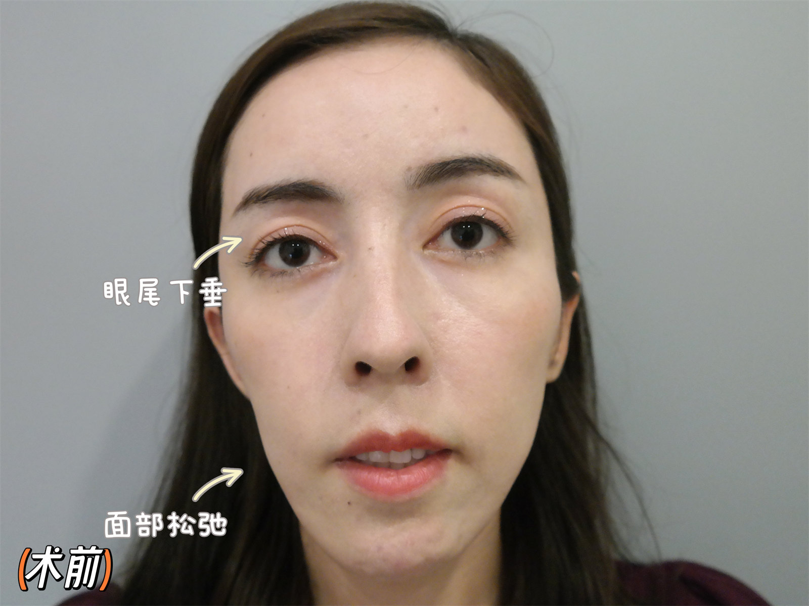 切眉术+小拉皮，微调之后的美，你觉得如何？