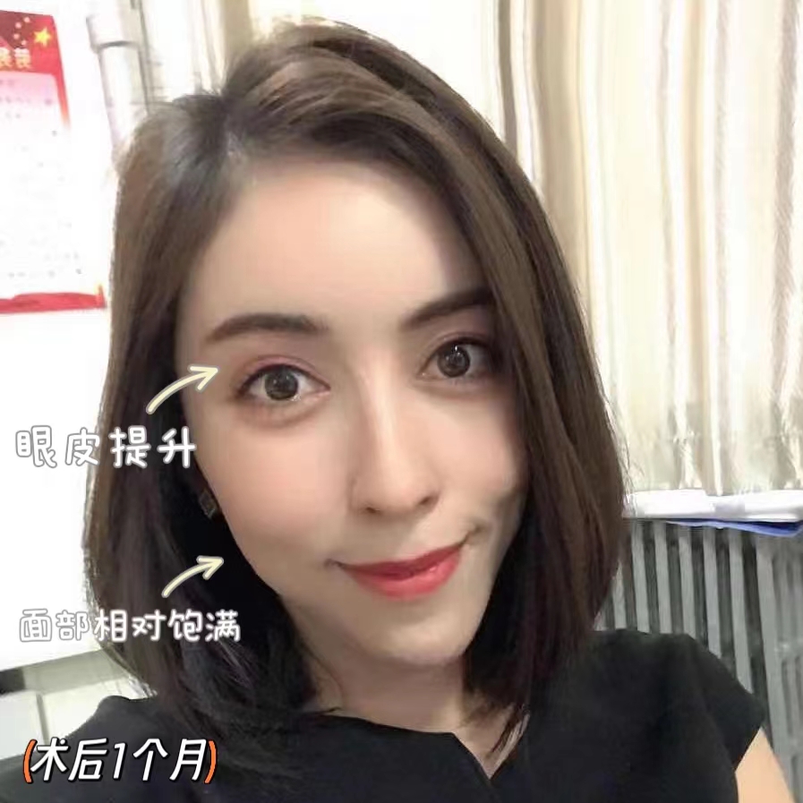 切眉术+小拉皮，微调之后的美，你觉得如何？