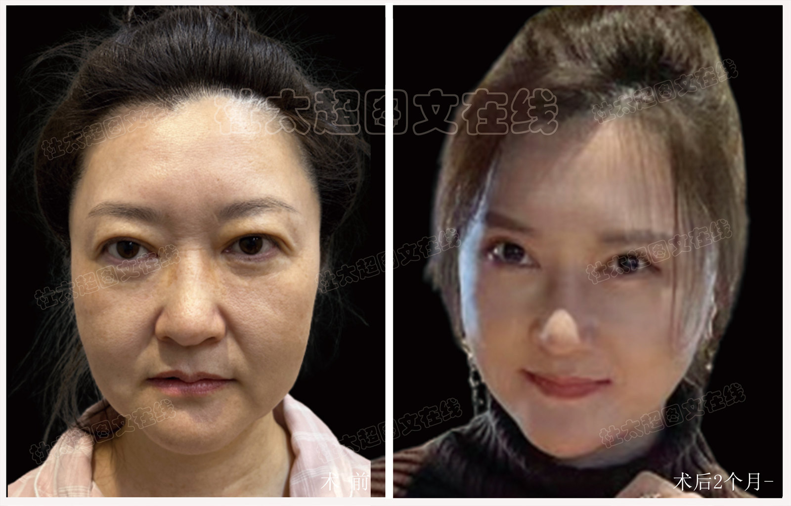 拉皮面部提升术后近期随访1个月