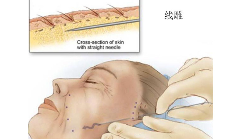面部提升怎么选?选线雕、热玛吉还是拉皮手术,过来人谈谈经验 面部提升怎么选?选线雕、热玛吉还是拉皮手术,过来人谈谈经验