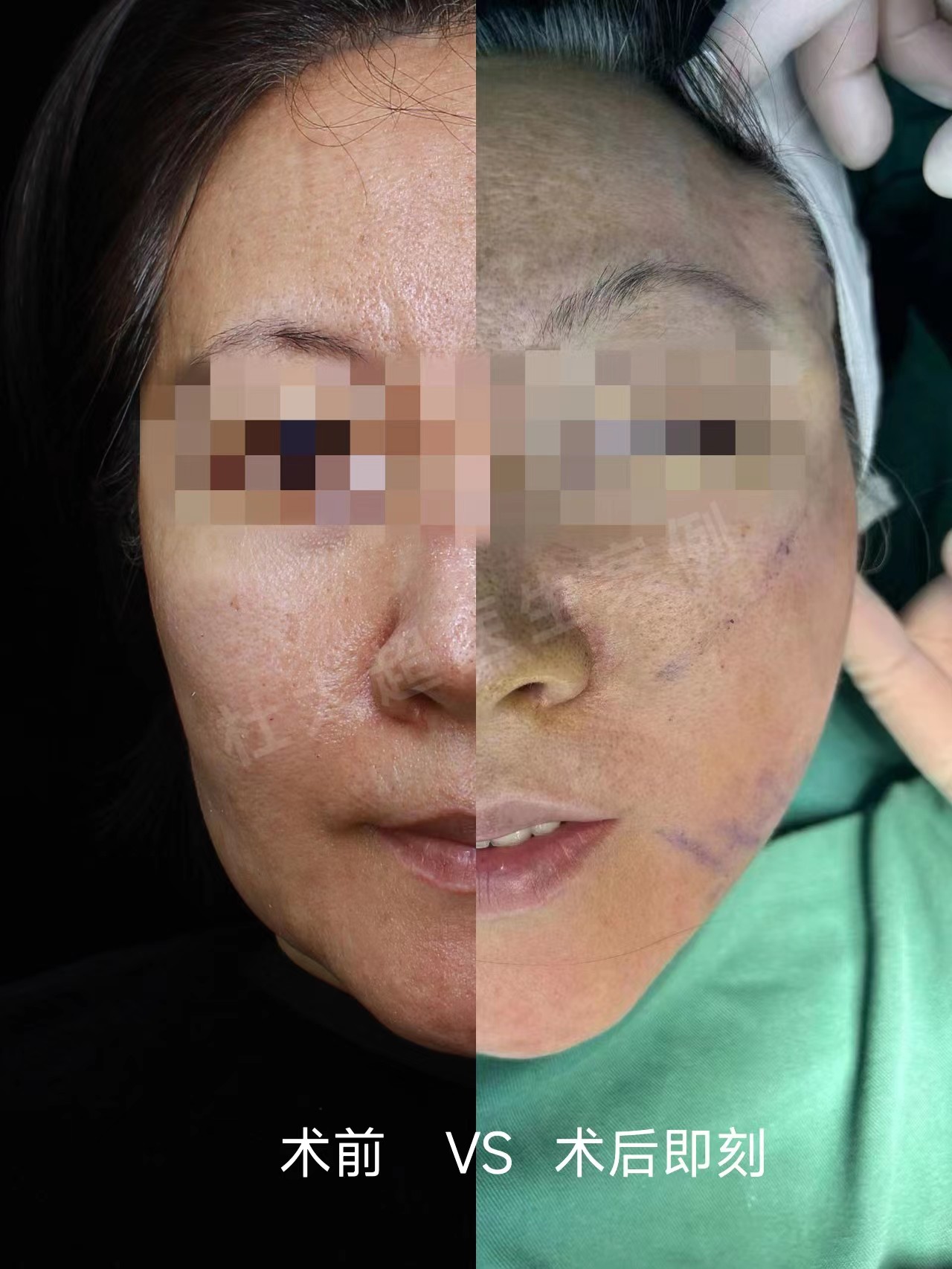 面部提升怎么选?选线雕、热玛吉还是拉皮手术,过来人谈谈经验 面部提升怎么选?选线雕、热玛吉还是拉皮手术,过来人谈谈经验