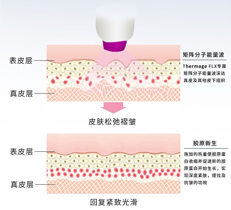 面部提升怎么选?选线雕、热玛吉还是拉皮手术,过来人谈谈经验 面部提升怎么选?选线雕、热玛吉还是拉皮手术,过来人谈谈经验