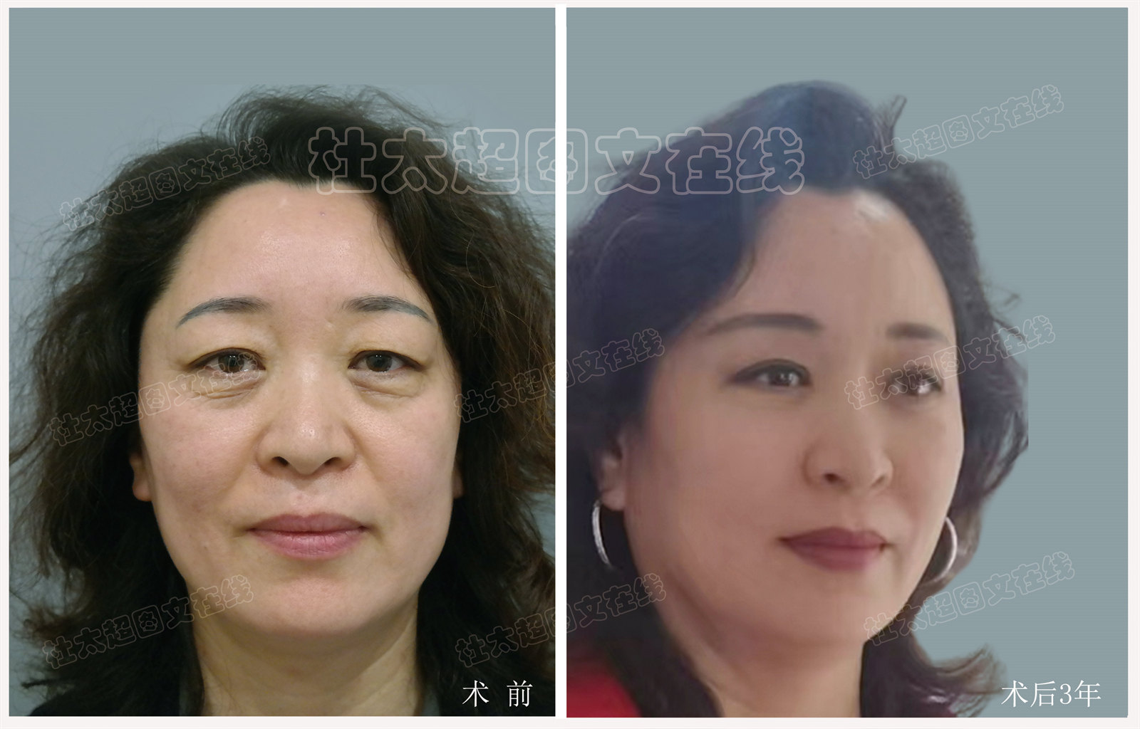 眼袋、泪沟、川字纹、眼皮提升术后3年