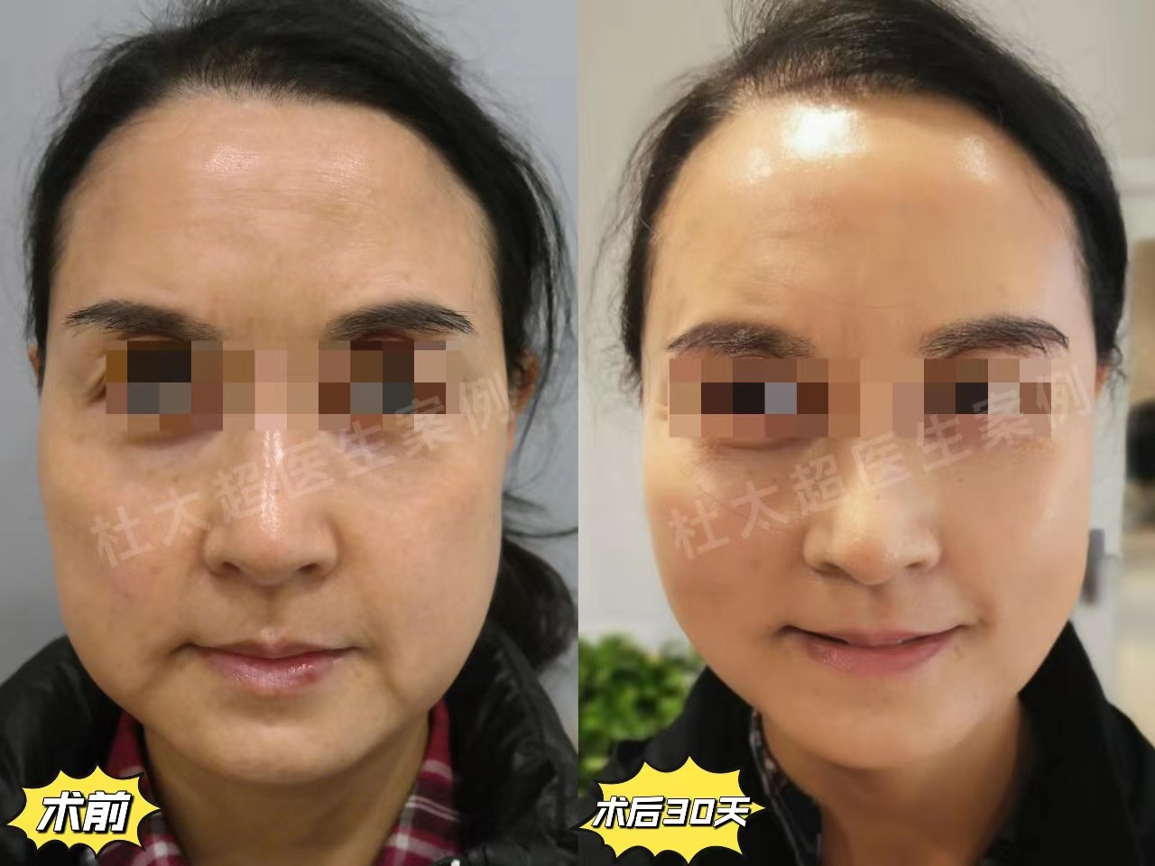 拉皮手术恢复期内成鬼,一个月后越来越美,亲身经历 拉皮手术恢复期内成鬼,一个月后越来越美,亲身经历