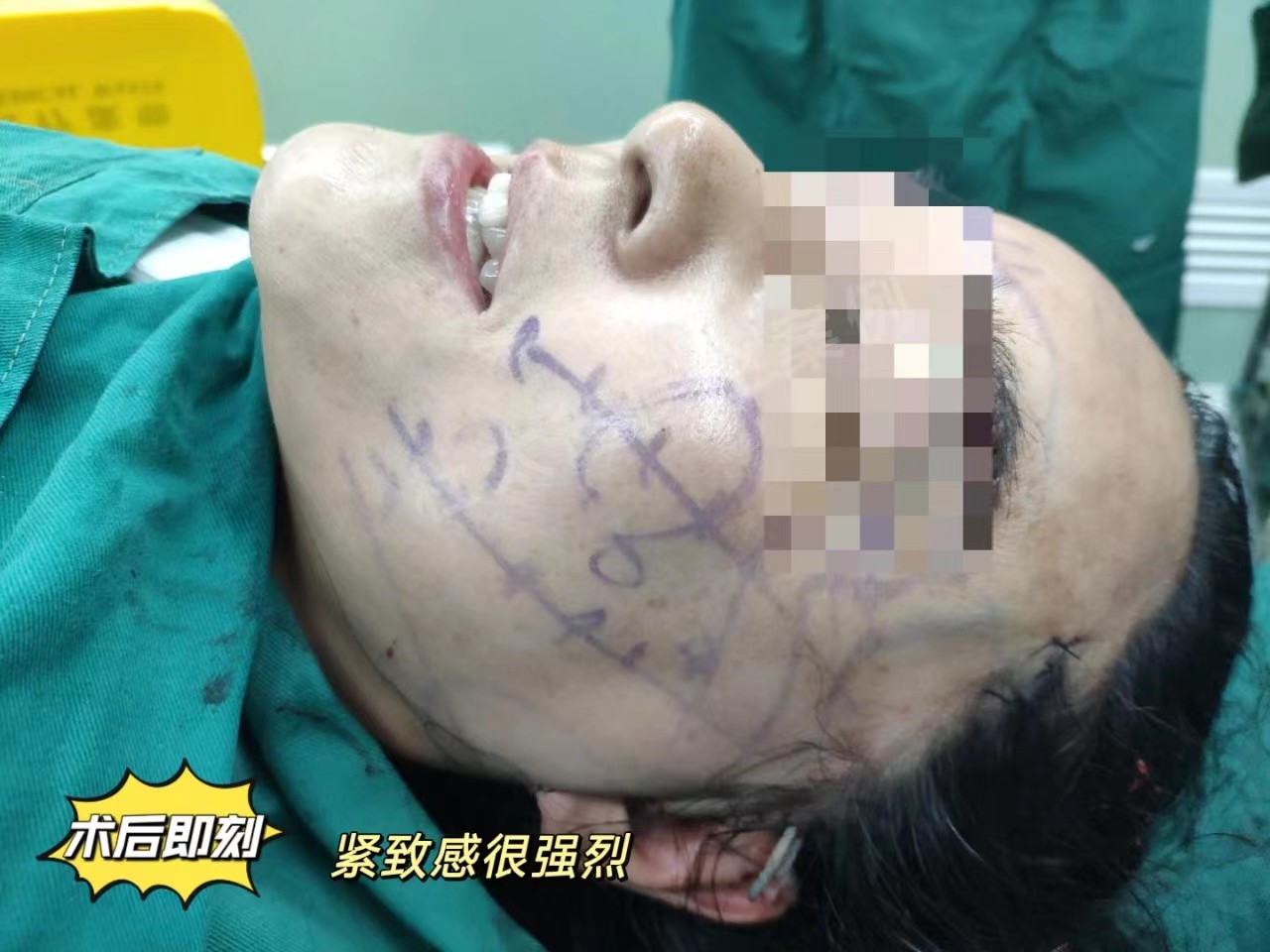 拉皮手术恢复期内成鬼,一个月后越来越美,亲身经历 拉皮手术恢复期内成鬼,一个月后越来越美,亲身经历