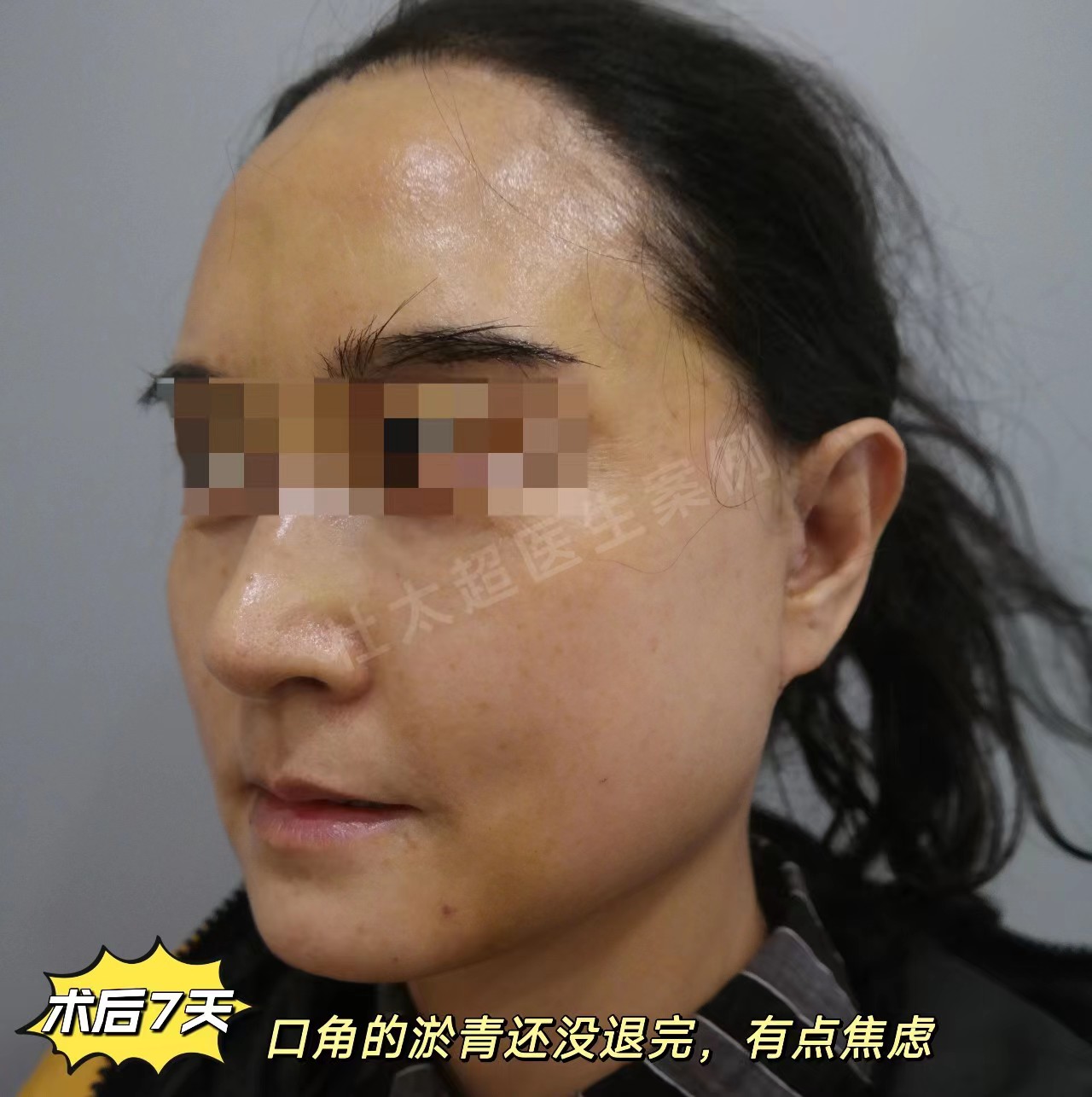 拉皮手术恢复期内成鬼,一个月后越来越美,亲身经历 拉皮手术恢复期内成鬼,一个月后越来越美,亲身经历