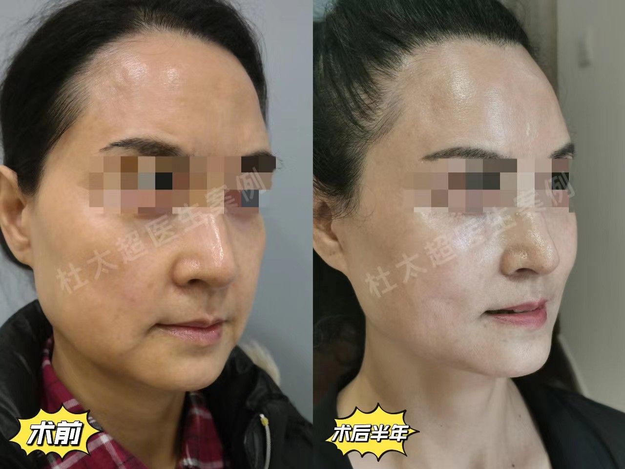 拉皮手术恢复期内成鬼,一个月后越来越美,亲身经历 拉皮手术恢复期内成鬼,一个月后越来越美,亲身经历