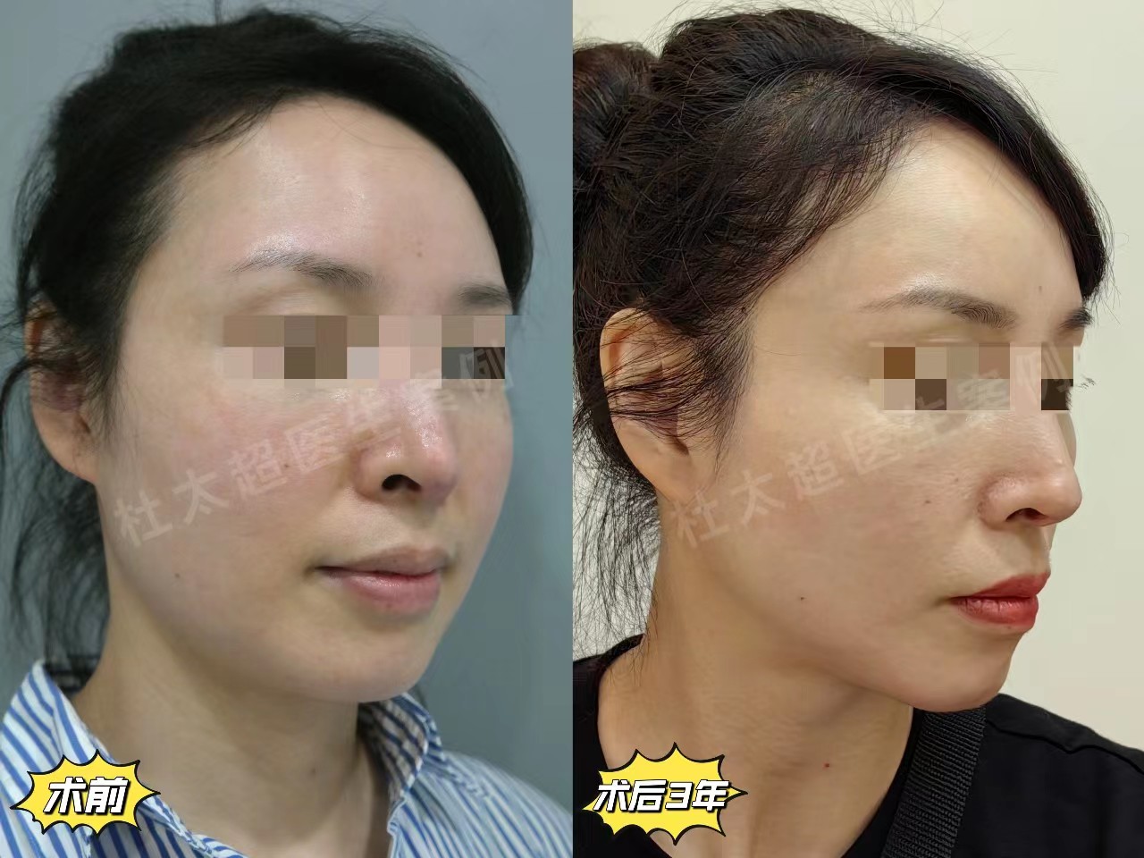 有过2次线雕经历和1次拉皮经历,给大家讲讲感受 有过2次线雕经历和1次拉皮经历,给大家讲讲感受