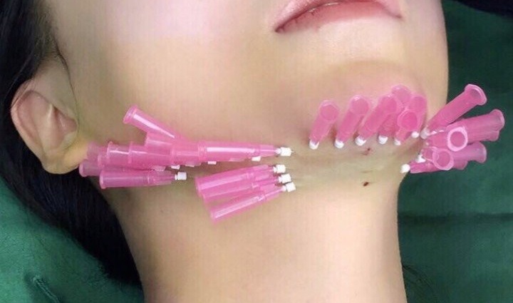 有过2次线雕经历和1次拉皮经历,给大家讲讲感受 有过2次线雕经历和1次拉皮经历,给大家讲讲感受