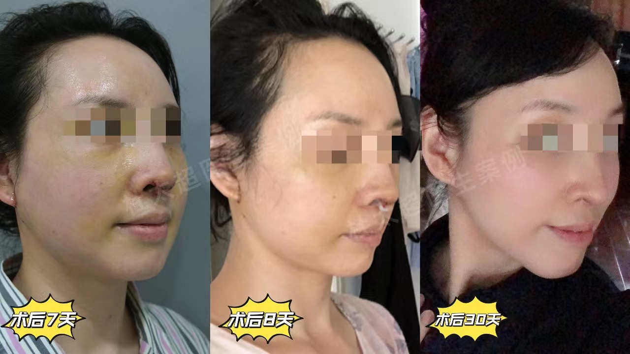 有过2次线雕经历和1次拉皮经历,给大家讲讲感受 有过2次线雕经历和1次拉皮经历,给大家讲讲感受