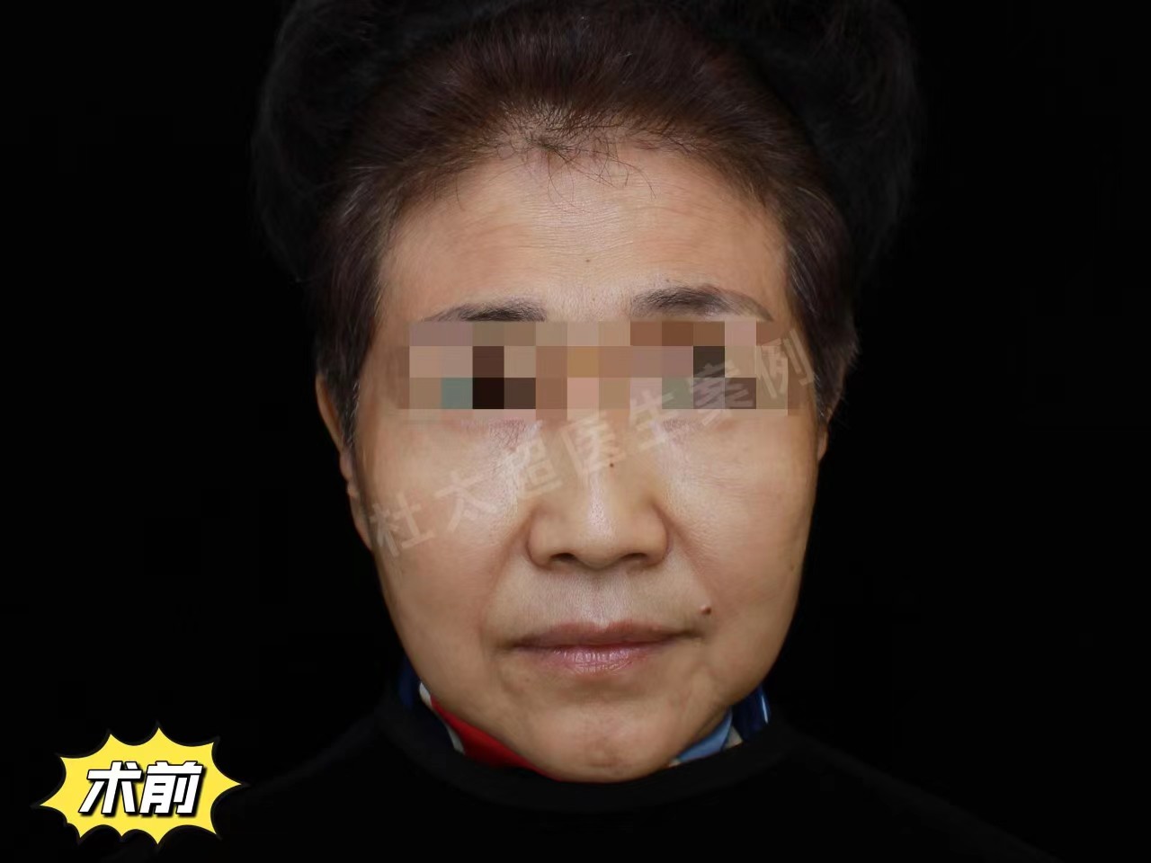 60岁女士做拉皮手术记录，分享恢复全过程