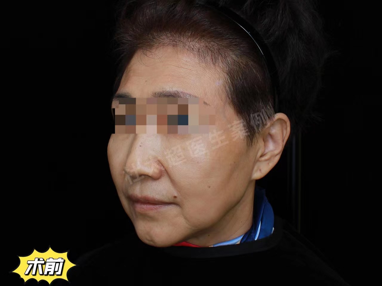 60岁女士做拉皮手术记录，分享恢复全过程