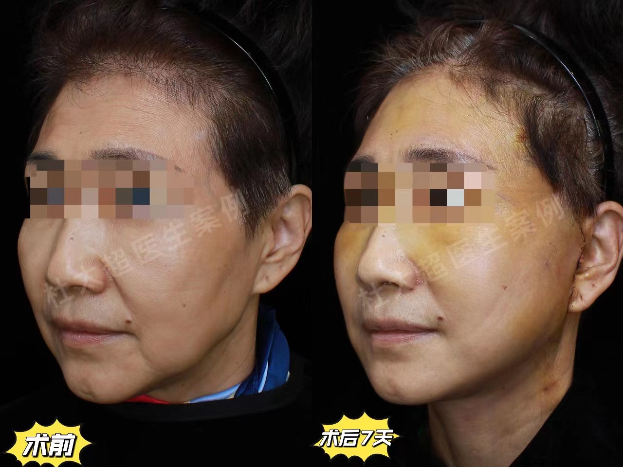 60岁女士做拉皮手术记录，分享恢复全过程