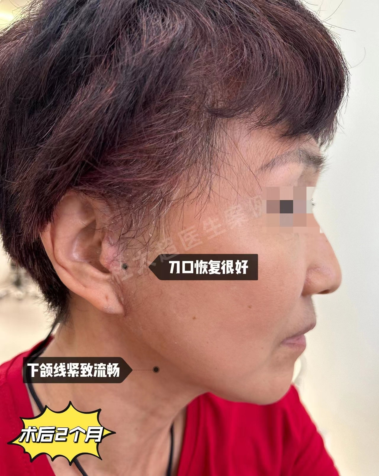 60岁女士做拉皮手术记录，分享恢复全过程