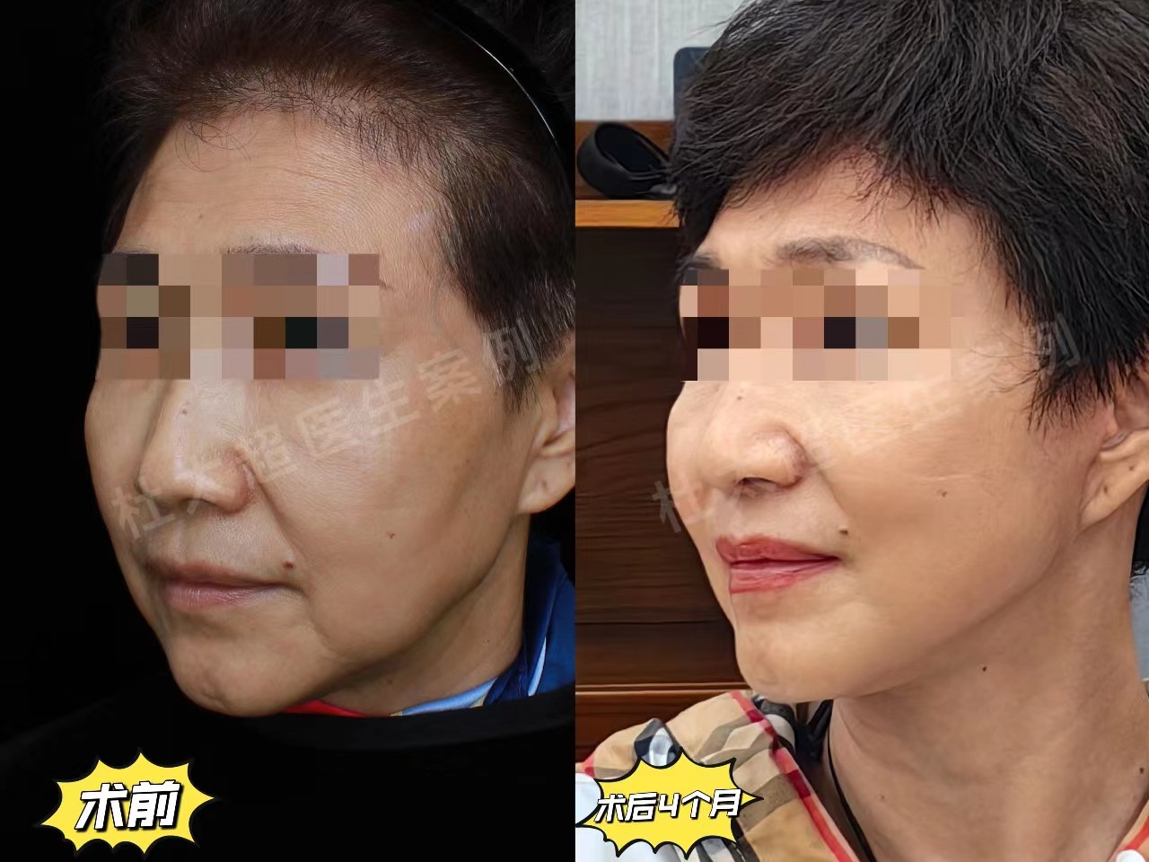 60岁女士做拉皮手术记录，分享恢复全过程