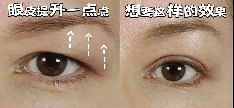 如何选择适合自己的眼部抗衰方式? 如何选择适合自己的眼部抗衰方式?