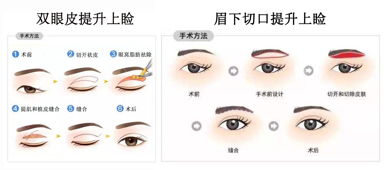 如何选择适合自己的眼部抗衰方式? 如何选择适合自己的眼部抗衰方式?