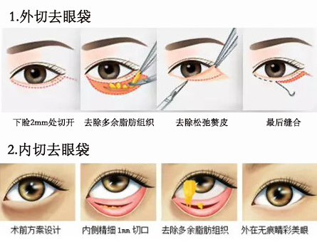 如何选择适合自己的眼部抗衰方式? 如何选择适合自己的眼部抗衰方式?