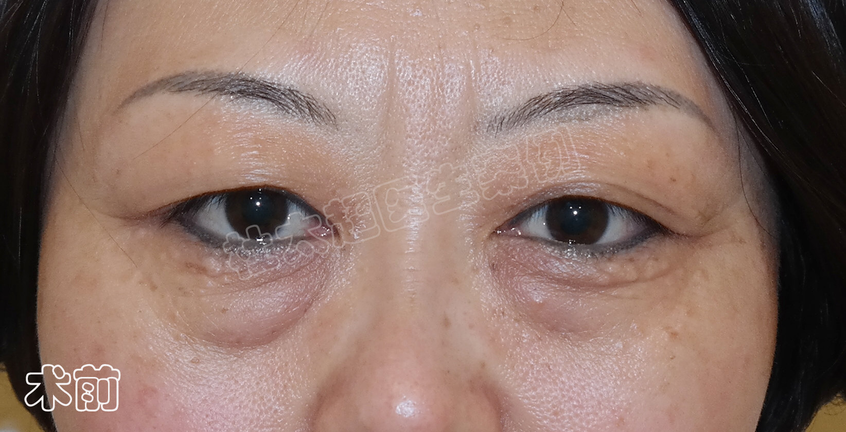 3个真人案例,告诉你如何选择适合自己的眼部抗衰方法! 3个真人案例,告诉你如何选择适合自己的眼部抗衰方法!