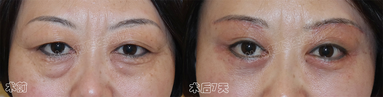 3个真人案例,告诉你如何选择适合自己的眼部抗衰方法! 3个真人案例,告诉你如何选择适合自己的眼部抗衰方法!