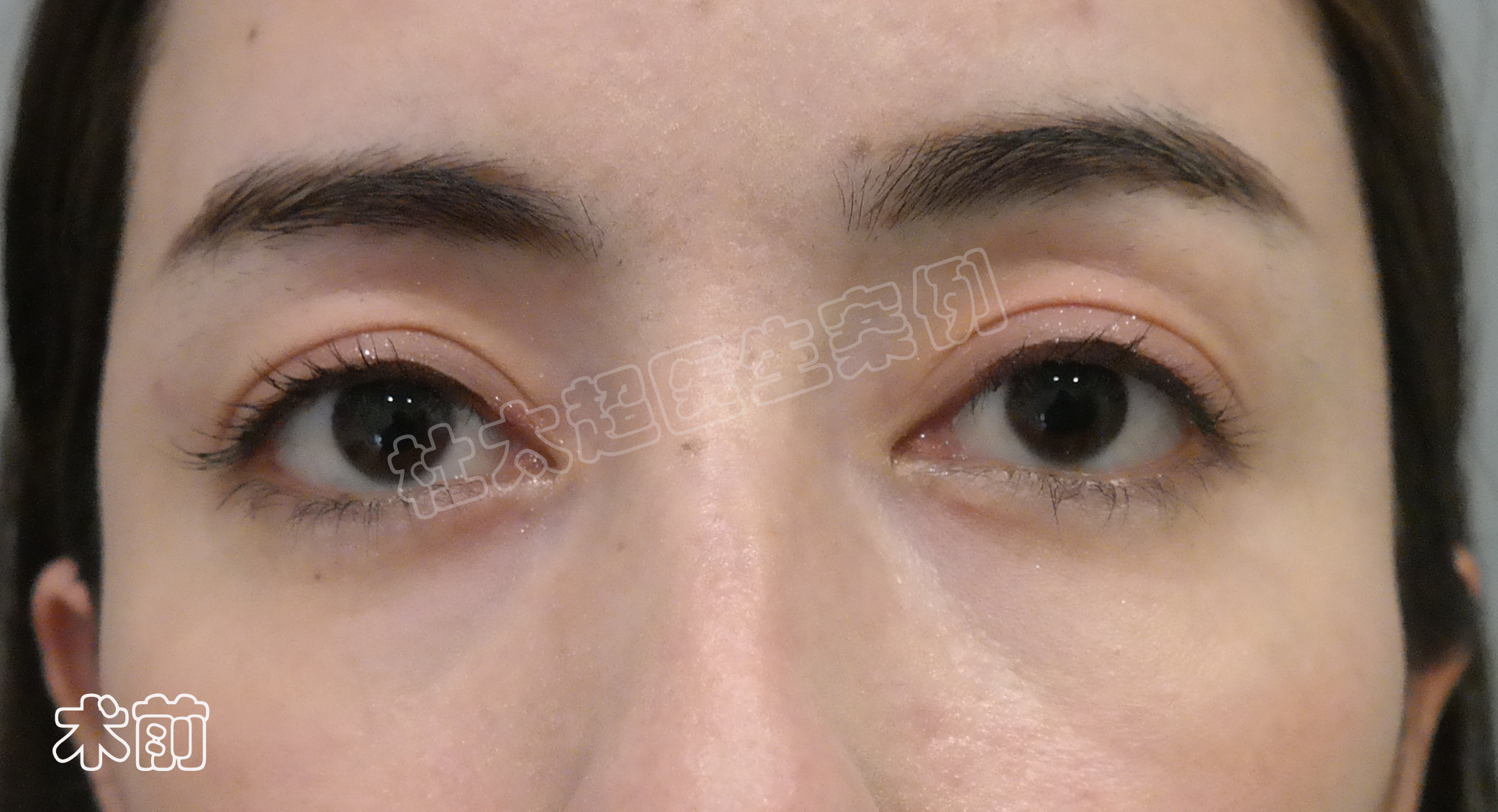 3个真人案例,告诉你如何选择适合自己的眼部抗衰方法! 3个真人案例,告诉你如何选择适合自己的眼部抗衰方法!