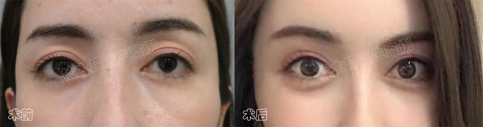 3个真人案例，告诉你如何选择适合自己的眼部抗衰方法！