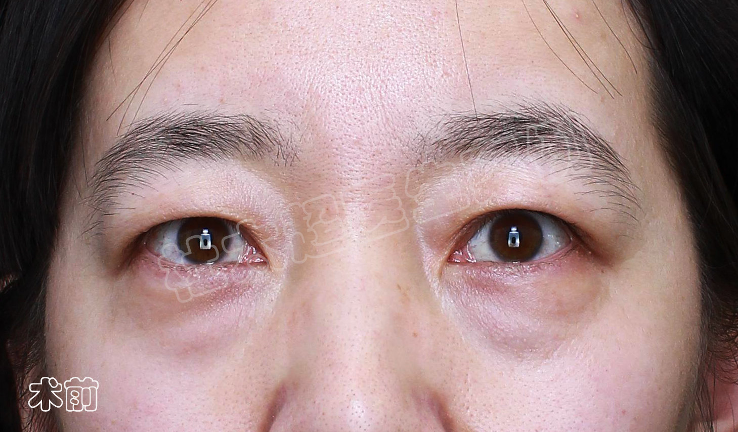 3个真人案例,告诉你如何选择适合自己的眼部抗衰方法! 3个真人案例,告诉你如何选择适合自己的眼部抗衰方法!