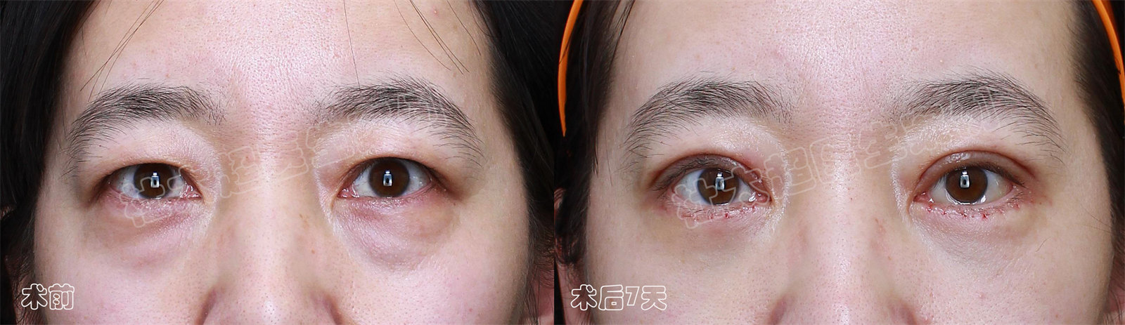 3个真人案例,告诉你如何选择适合自己的眼部抗衰方法! 3个真人案例,告诉你如何选择适合自己的眼部抗衰方法!