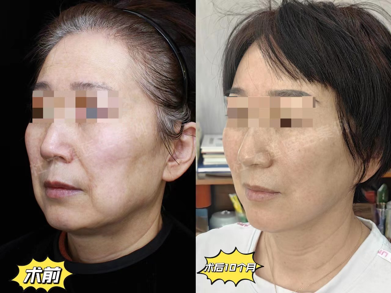 我在56岁做了拉皮提升手术,术后不到1年,亲姐姐行动了 我在56岁做了拉皮提升手术,术后不到1年,亲姐姐行动了