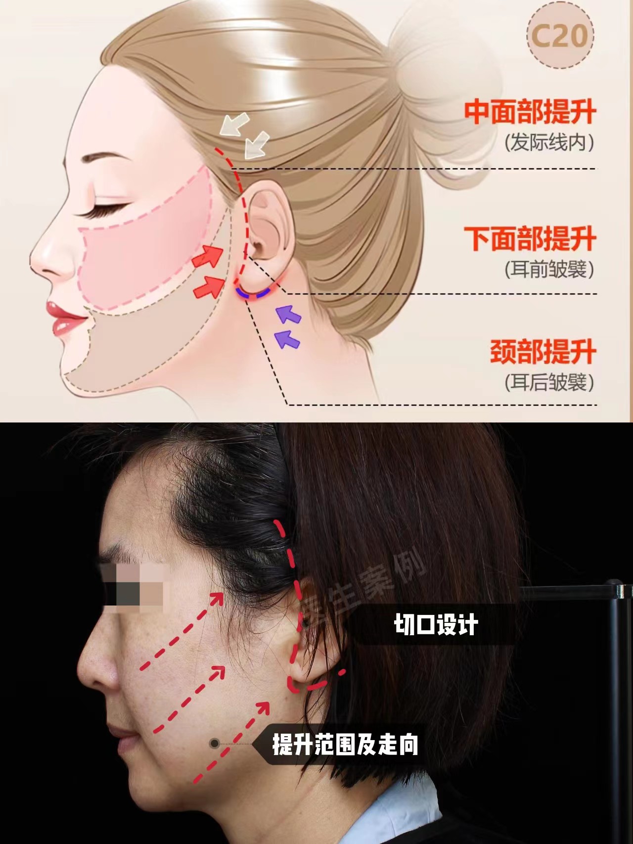 48岁安徽女士专程到北京做拉皮手术,术后反馈不枉此行 48岁安徽女士专程到北京做拉皮手术,术后反馈不枉此行