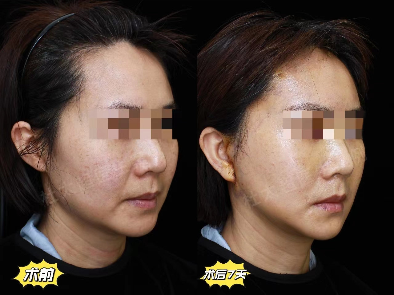 48岁安徽女士专程到北京做拉皮手术,术后反馈不枉此行 48岁安徽女士专程到北京做拉皮手术,术后反馈不枉此行