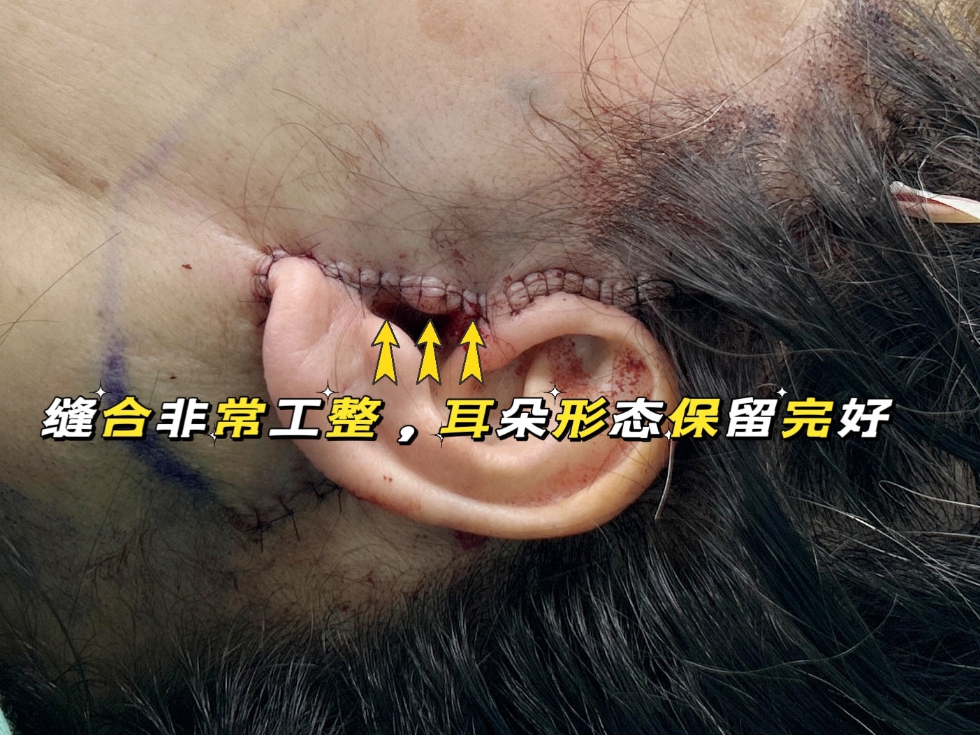 55岁面部脂肪堆积、皮肤松弛下垂，公开手术改善全过程