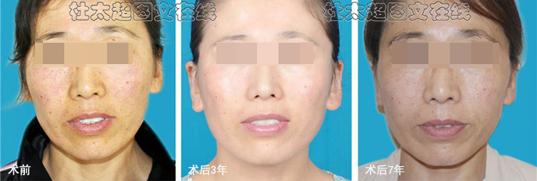 7年前做了拉皮提升,变得很抗老,同龄人都羡慕! 7年前做了拉皮提升,变得很抗老,同龄人都羡慕!