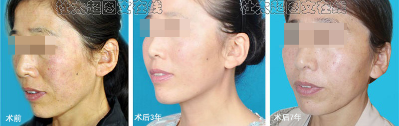 7年前做了拉皮提升,变得很抗老,同龄人都羡慕! 7年前做了拉皮提升,变得很抗老,同龄人都羡慕!