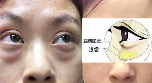 出现眼袋如何解决？当然要对症治疗了