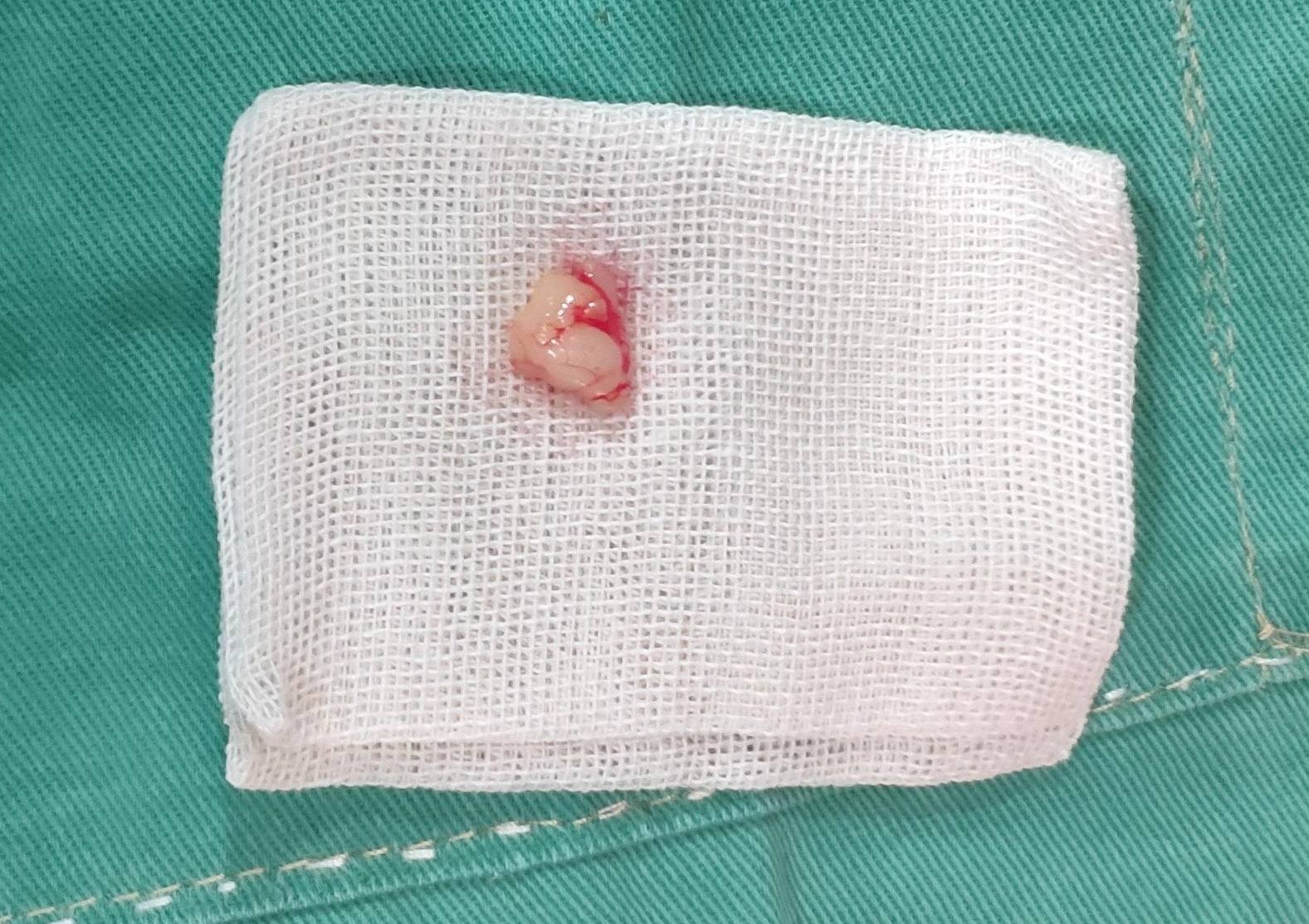 去眼袋全过程记录，看看这效果到底值不值！