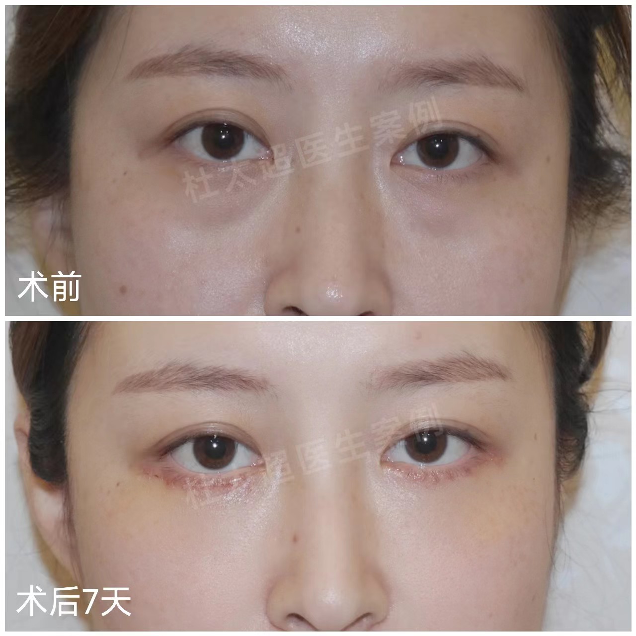 去眼袋全过程记录，看看这效果到底值不值！