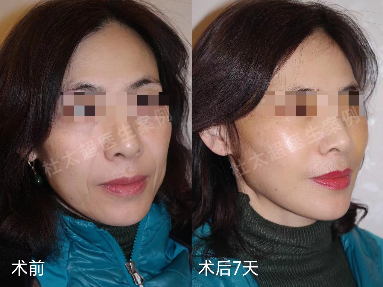 拉皮最难熬的阶段？不是术中、不是术后、而是......