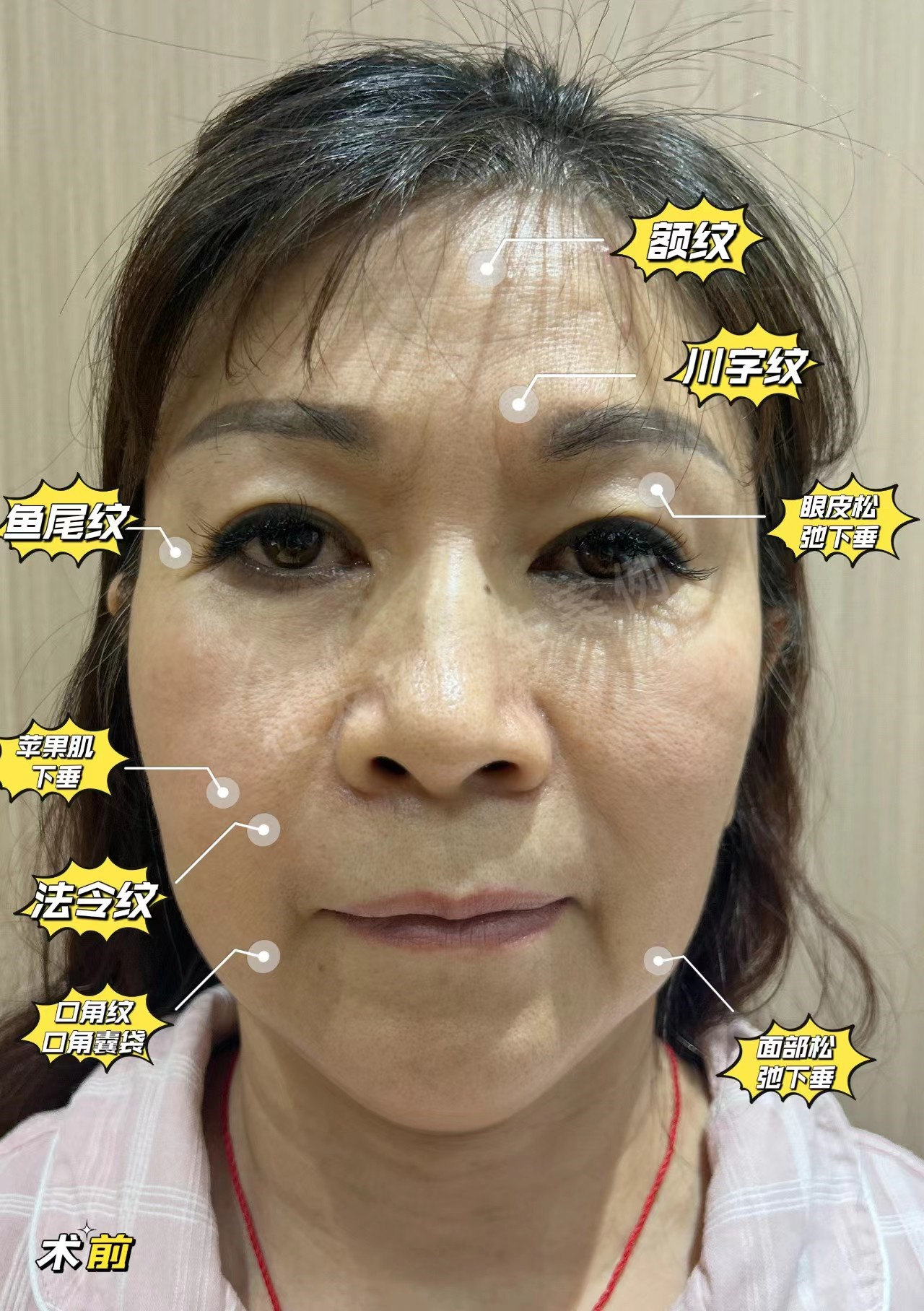 58岁追求青春容颜，不惜做了拉皮手术，没白遭罪！