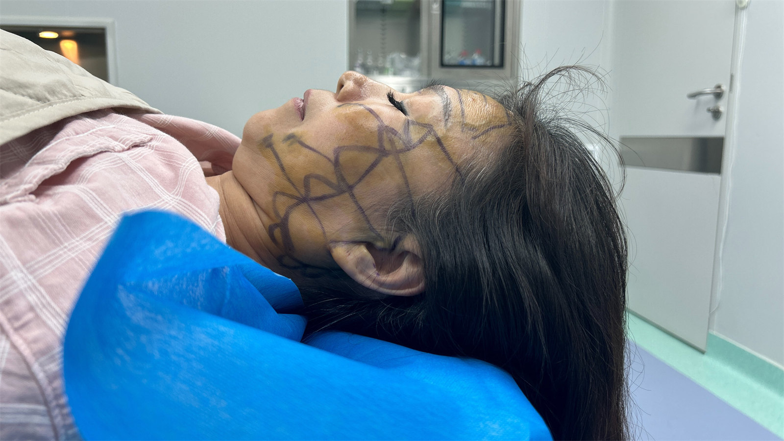 58岁追求青春容颜，不惜做了拉皮手术，没白遭罪！