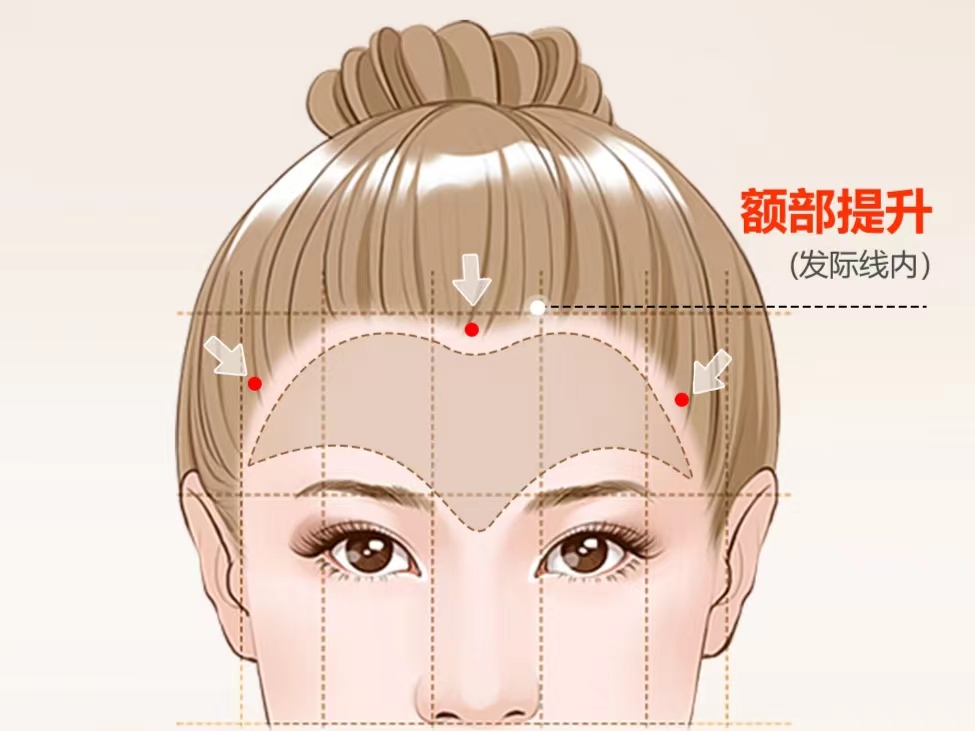 作为过来人，写给准备做除皱手术朋友的一封信！