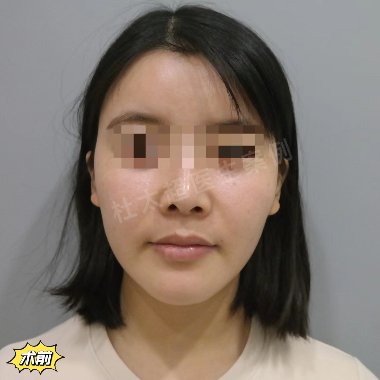 年轻人可以做拉皮手术吗？