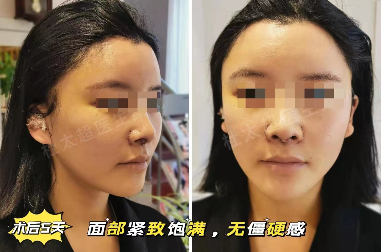 年轻人可以做拉皮手术吗？