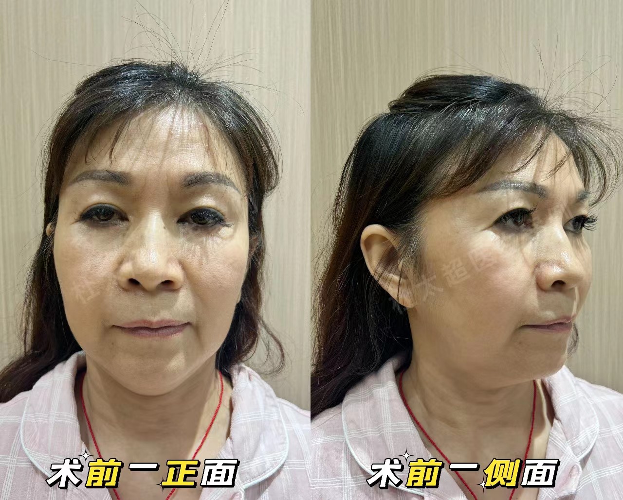 拉皮手术后能年轻多少岁？3个真人案例带你公布答案