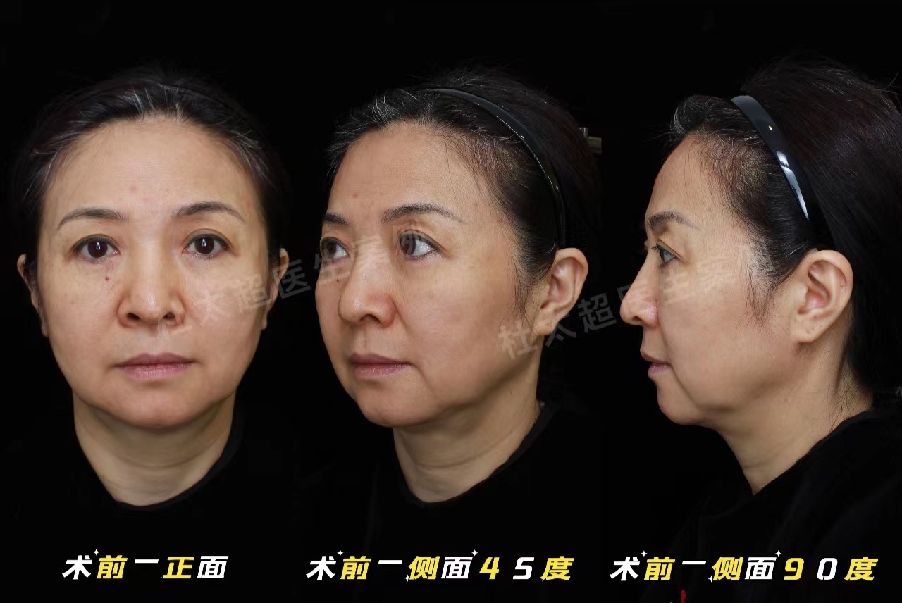 拉皮手术后能年轻多少岁？3个真人案例带你公布答案